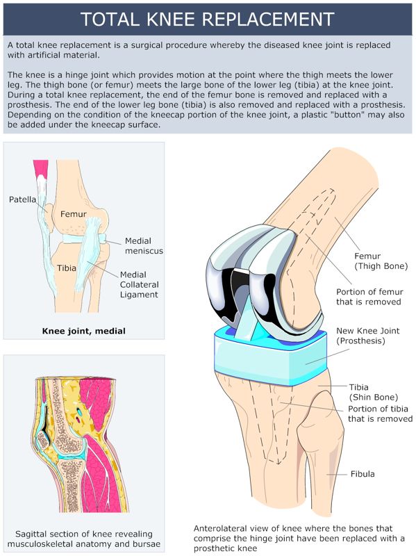 TOTAL_KNEE_REPLACEMENT