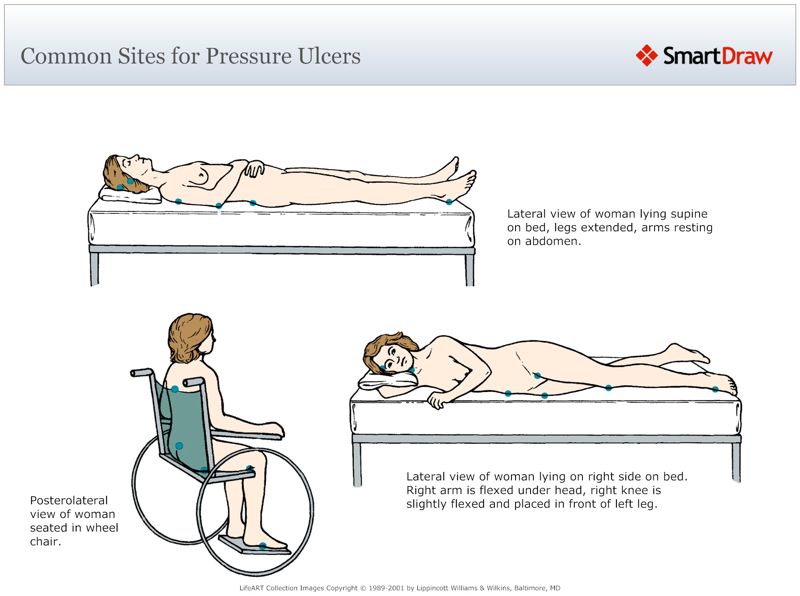 Common_Sites_for_Pressure_Ulcers