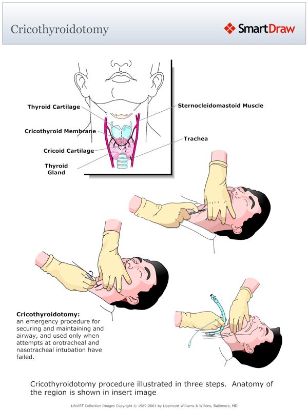 Cricothyroidotomy