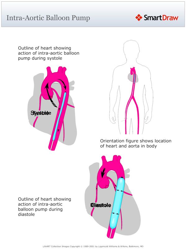 Intra-Aortic_Balloon_Pump