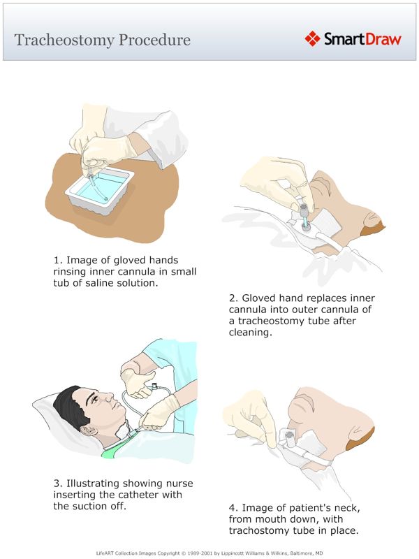 Tracheostomy_Procedure