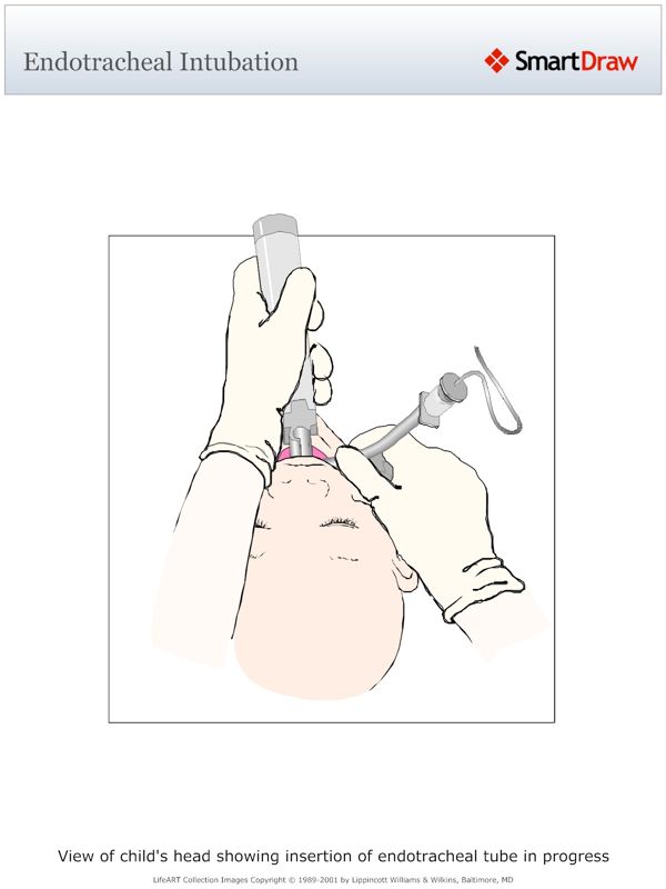 Endotracheal_Intubation