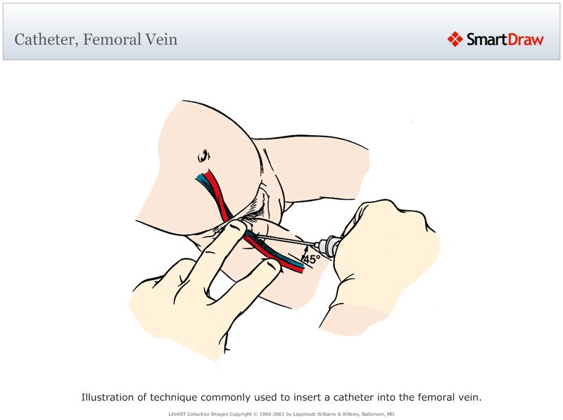 Catheter,_Femoral_Vein