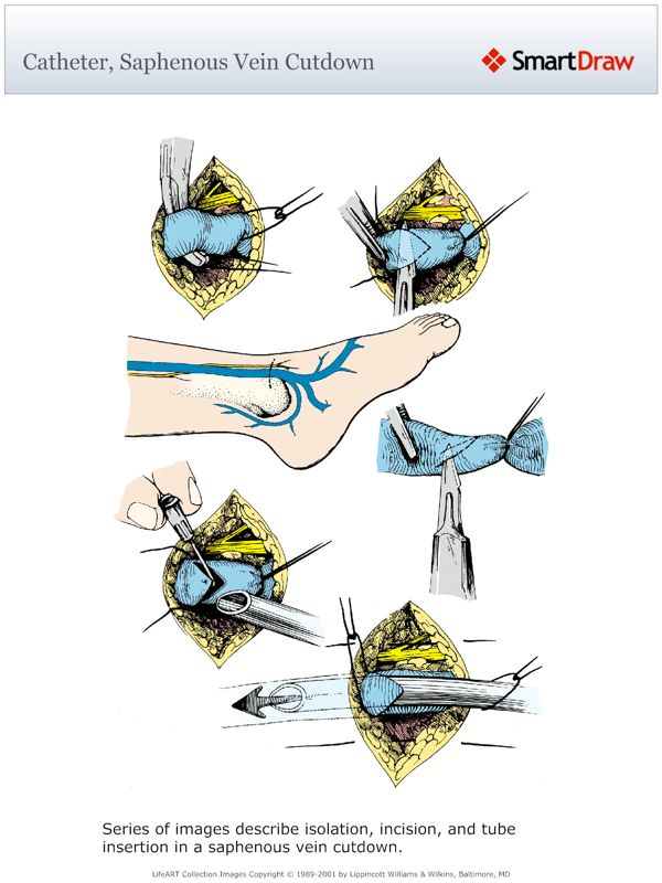Catheter,_Saphenous_Vein_Cutdown