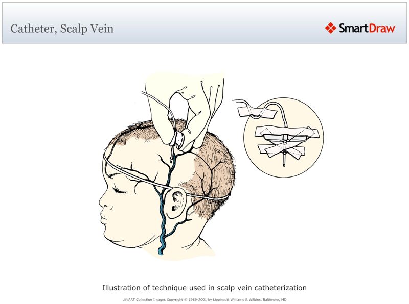 Catheter,_Scalp_Vein