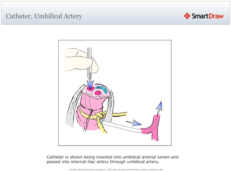 Catheter,_Umbilical_Artery
