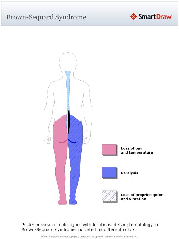 Brown-Sequard_Syndrome