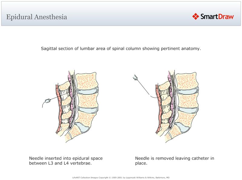 Epidural_Anesthesia