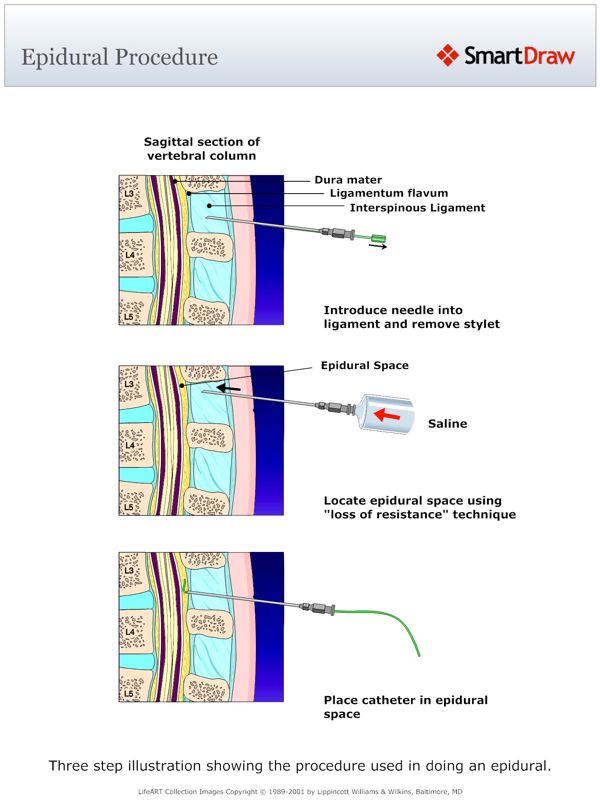 Epidural_Procedure