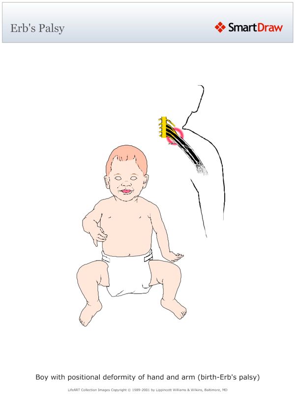 Erb's_Palsy