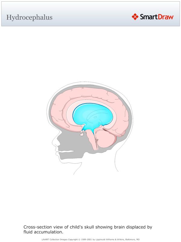 Hydrocephalus