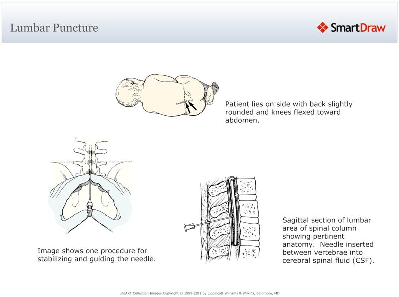 Lumbar_Puncture2
