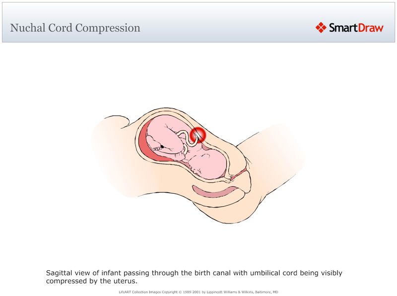 Nuchal_Cord_Compression