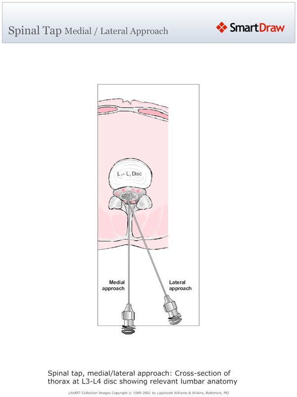 Spinal_Tap_Medial_-_Lateral_Approach
