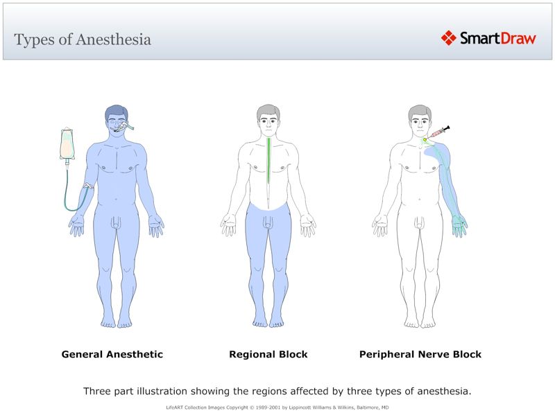 Types_of_Anesthesia