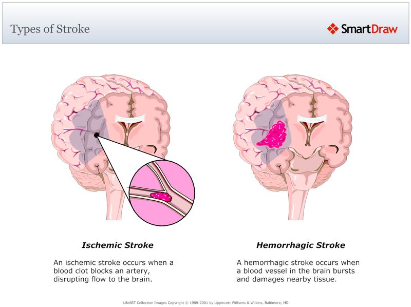Types_of_Stroke