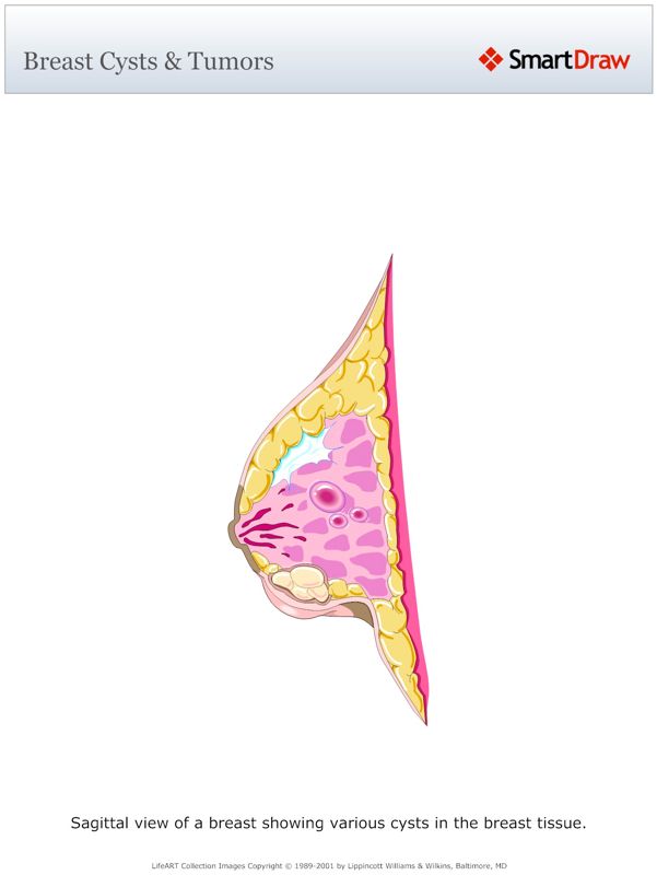 Breast_Cysts_&_Tumors