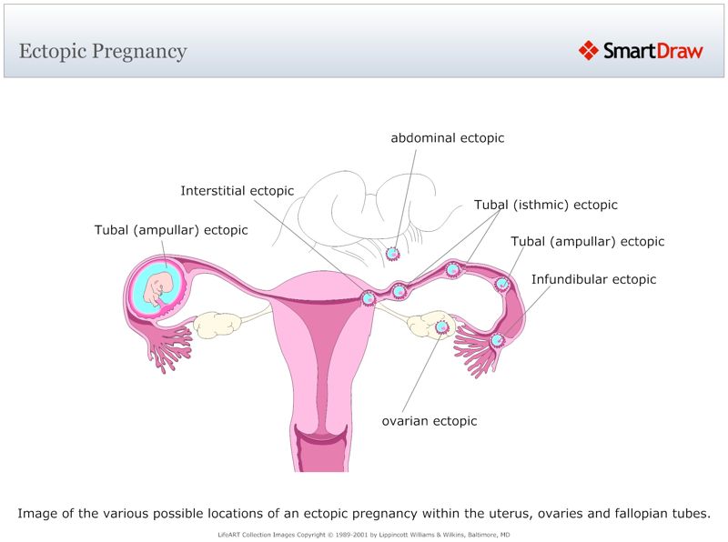 Ectopic_Pregnancy
