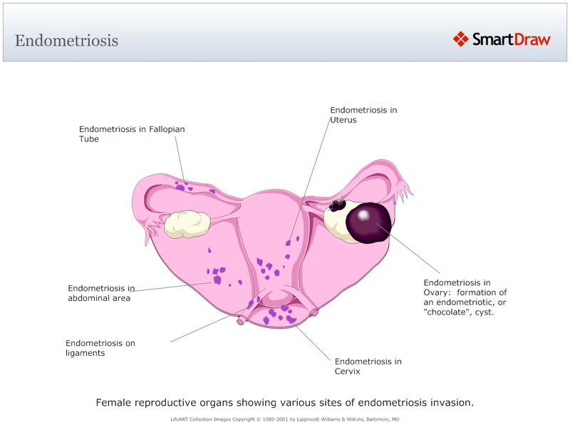 Endometriosis