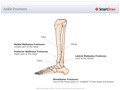 Ankle_Fractures