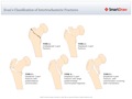 Evan's_Classification_of_Intertrochanteric_Fractures
