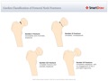 Garden_Classification_of_Femoral_Neck_Fractures