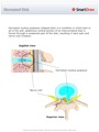 Herniated_Disk