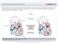 Ventricular_Septal_Defect_(VSD)
