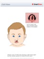 Cleft_Palate