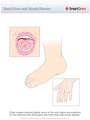 Hand-Foot-and-Mouth_Disease