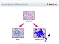 Normal_Benign_&_Malignant_Tissue