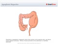 Aganglionic_Megacolon