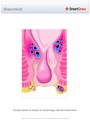 Hemorrhoid
