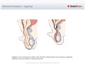 Hernia_Formation_-_Inguinal