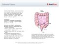 Colorectal_Cancer