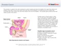 Prostate_Cancer