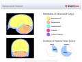 Intracranial_Tumors
