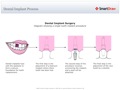 Dental_Implant_Process