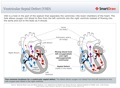 Ventricular_Septal_Defect_(VSD)