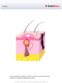Acne