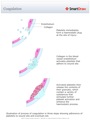 Coagulation