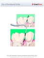 Use_of_Periodontal_Probe
