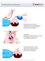 Endotracheal_Intubation