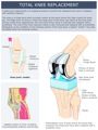 TOTAL_KNEE_REPLACEMENT
