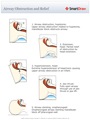 Airway_Obstruction_and_Relief