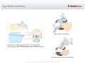 Bag-Mask_Ventilation