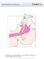 Endotracheal_Intubation2