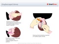 Oropharyngeal_Airway