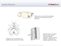 Lumbar_Puncture2