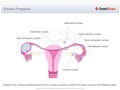 Ectopic_Pregnancy